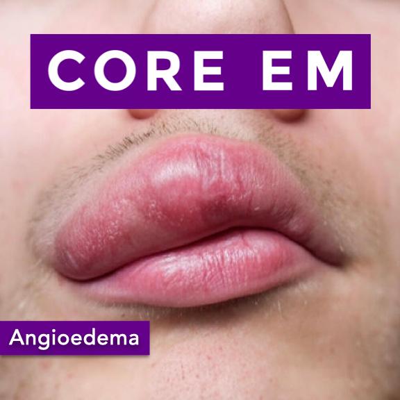 https://coreem.net/content/uploads/2025/08/Angioedema.001-1.jpeg
